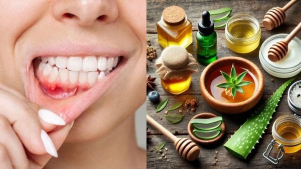 வாய்ப்புண் பிரச்சனைக்கு சிறந்த இயற்கை தீர்வுகள் | Best Natural Remedies for Mouth Ulcer
