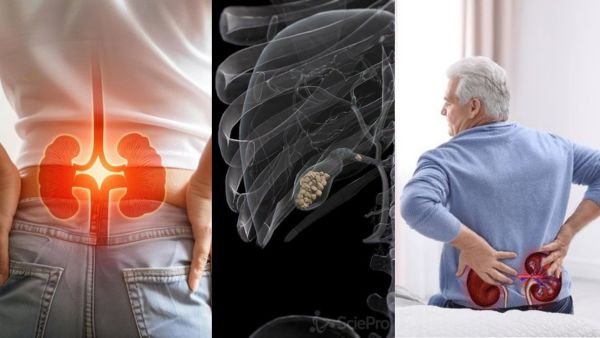 சிறுநீரகம் பித்தப்பை கற்கள் : கரைக்கும் 4 Easy Tips - Kidney Gallbladder Stones Remedy in Tamil