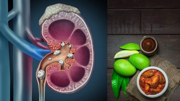 ஊறுகாய் அதிகம் சாப்பிடுவதால் Kidney Stone வர வாய்ப்பு - Doctors Health Advice!