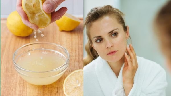 முகப் பருவுக்கு எலுமிச்சை சாறு நல்லதா கெட்டதா? Lemon Juice for Acne - Doctor Advice!