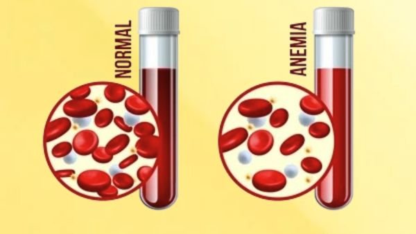 Anemia Iron Deficiency Causes - பெண்களுக்கு ரத்த சோகை ஏற்படுவதற்கான காரணங்கள்!